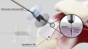 FDA Clearance for FiberLocker® System